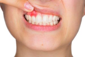 elfbar elfa kaufen Is Vaping Bad for Your Teeth?